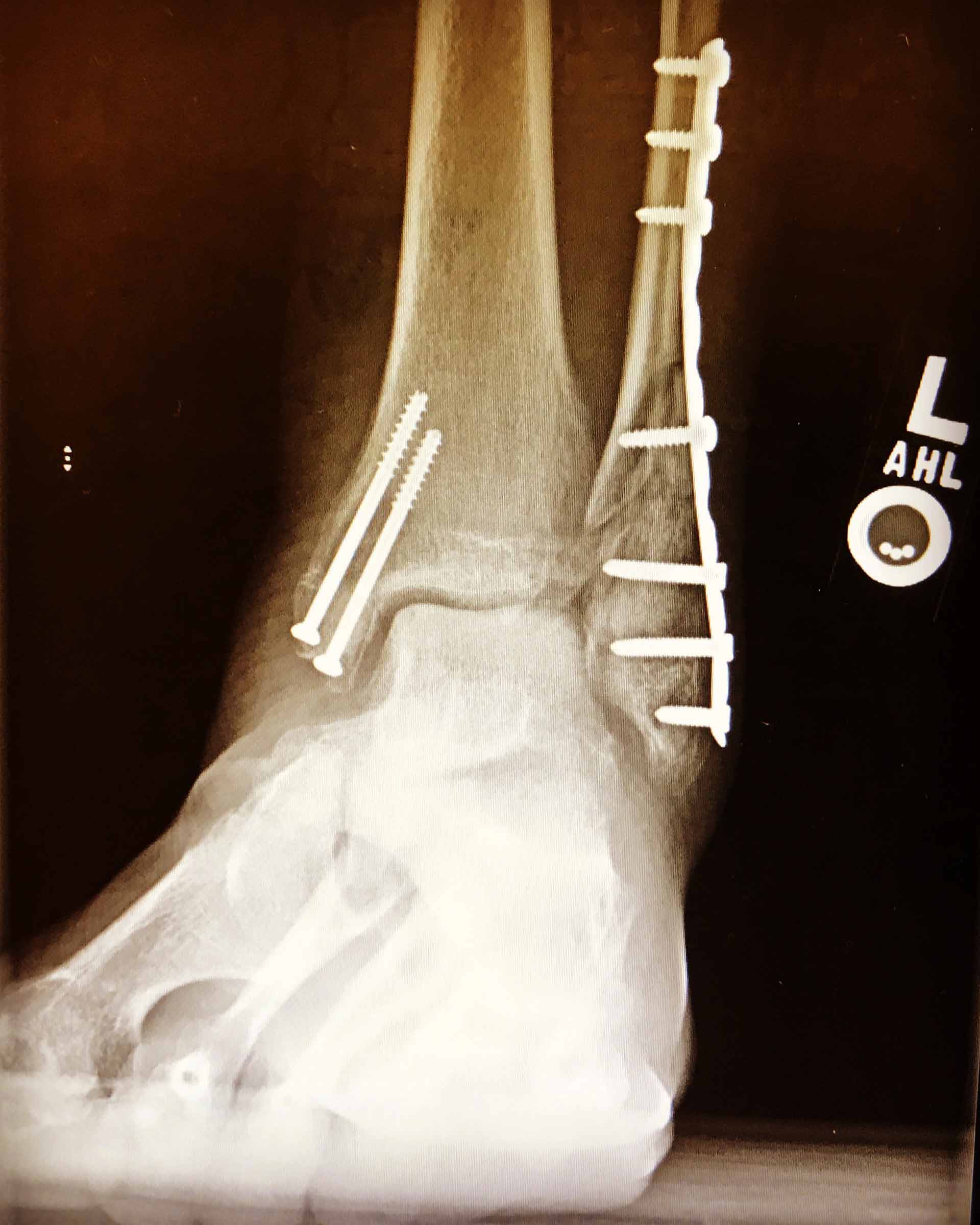 THE ROAD TO RECOVERY – 4 MONTH UPDATE THE ROAD TO RECOVERY – 4 MONTH UPDATE